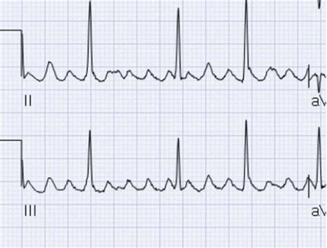 Ekgs Flashcards Quizlet