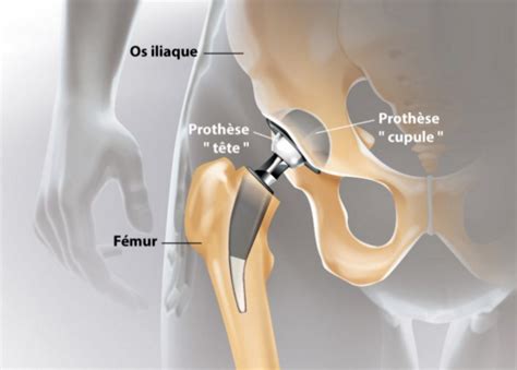 Une nouvelle technique de pose dune prothèse totale de la hanche