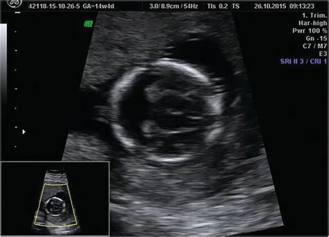 21 Weeks Pregnant Ultrasound Face