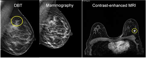 Cancers Free Full Text Current Landscape Of Breast Cancer Imaging