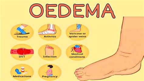 OEDEMA | TYPE OF OEDEMA | OEDEMA'S CAUSES - YouTube