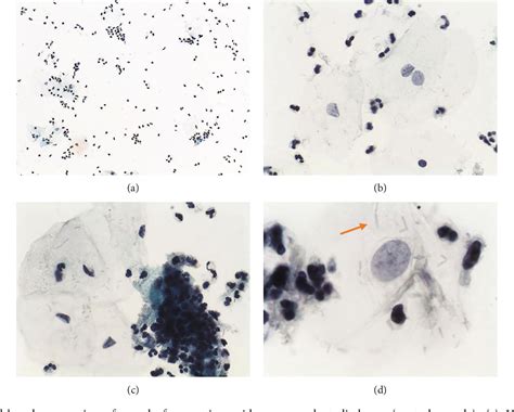 Figure From Cervical Cytology Of Samples With Ureaplasma Urealyticum