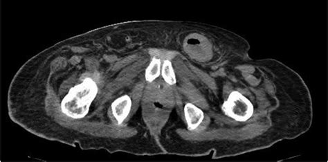 Inguinal Hernia Ct Scan