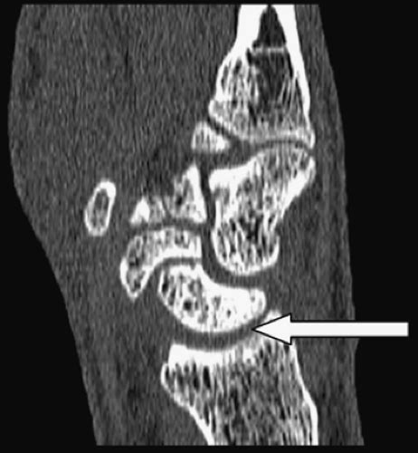 The Malerich Procedure Distal Scaphoid Resection Musculoskeletal Key