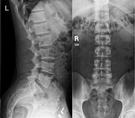 Lumbar Spine Xray