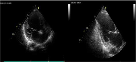 Two Dimensional Echocardiogram Shows Left Ventricular Apical Thrombus