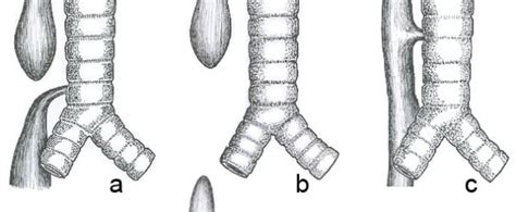 Common Anatomical Types Of Oesophageal Atresia A Oesophageal Atresia