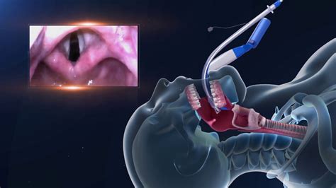 Ue Video Laryngoscope Demo Youtube