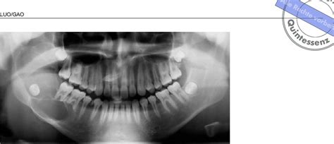 Panoramic Radiograph Revealing Multilocular Radiolucency Of Right