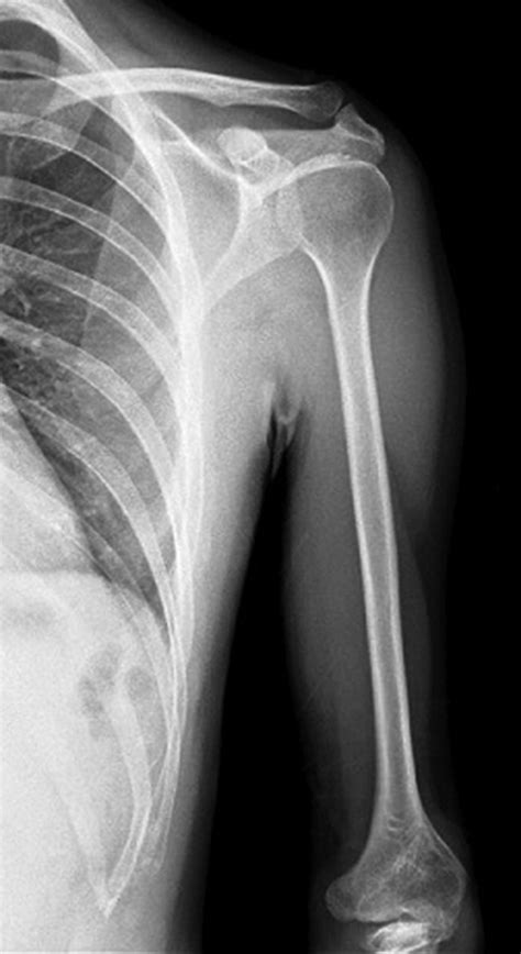 Anteroposterior Radiograph Of The Left Arm Showing Normal Shoulder