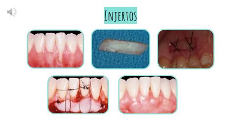 Procedimientos Regenerativos En Cirugia Periodontal YouTube