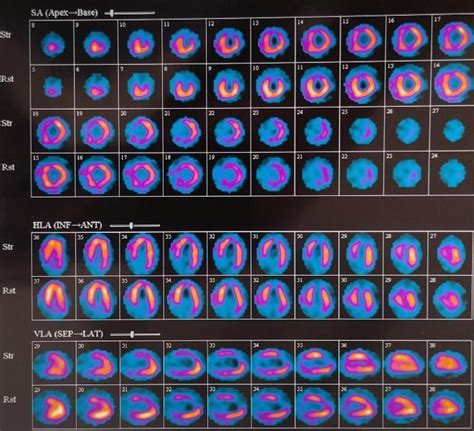 Case Report Of Symptomatic Very Late Presentation Of ALCAPA Syndrome