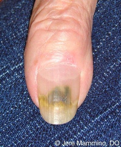 Some Of Green Nail Syndrome (GNS, Pseudomonas nail infection – Telegraph