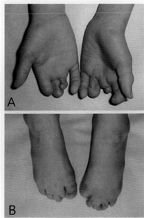 Figure 2 From Congenital Bilateral Perisylvian Syndrome Associated With