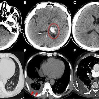 Ac General Cranial Computed Tomography Scan A Cm Left