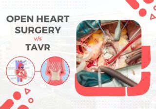 Open Heart Surgery Vs TAVR A Comparative Analysis Dr C Raghu