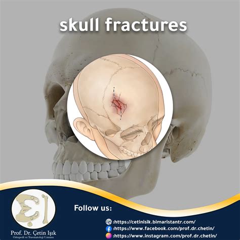 Skull fractures - the most important symptoms and treatment methods - Dr. What's wrong with you?