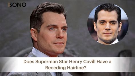 Does Superman Star Henry Cavill Have A Receding Hairline