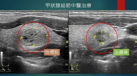 工作壓力大、生活步調快易好發甲狀腺結節，中藥治療消腫助縮小 台中慈濟醫院 健康遠見