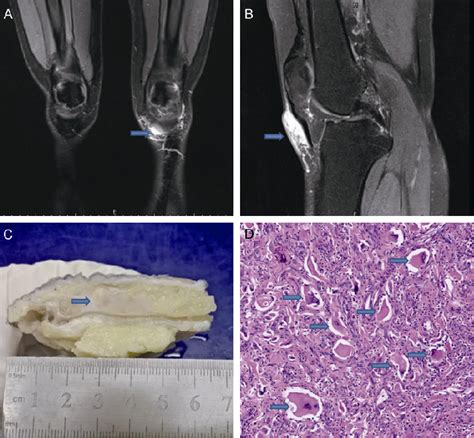 Figure 1 From Outcomes Of Cutaneous Indeterminate Dendritic Cell Tumors