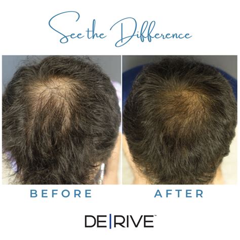 DE|RIVE Hair Restoration | Edmonton | Aspen Aesthetics