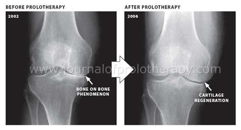 Standard Clinical X Ray Studies Document Cartilage Regeneration In Five