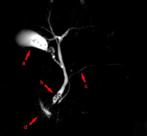 Biliary Colic And Cholecystitis Teachmesurgery