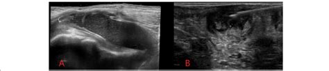 Ultrasound Image A Demonstrating A Soft Tissue Groin Abscess In An Download Scientific