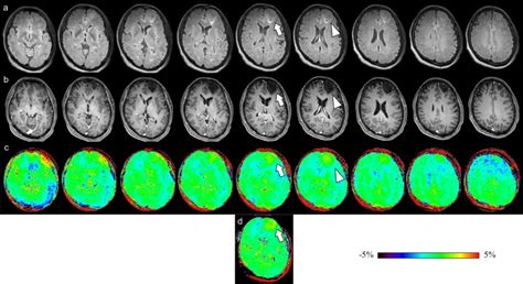 Grading Of Gliomas Using 3D CEST Imaging With Compressed Sensing And