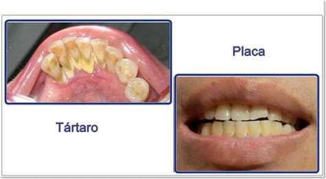 Tártaro e Placa dental O que é e como elimina lo