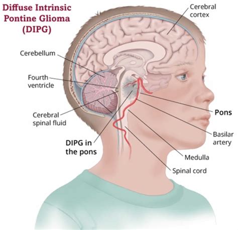 Dipg Causes Signs Symptoms Diagnosis Treatment Prognosis