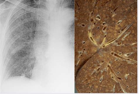 Tuberculosis Lungs