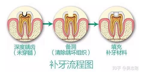 补牙全过程，看看牙医在你嘴里做了什么？ 知乎