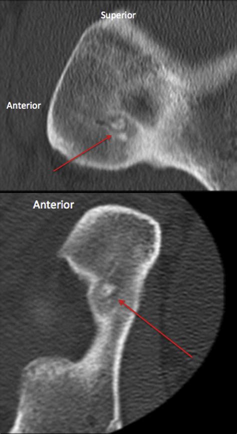 Arthroscopic Excision Of Acetabular Osteoid Osteoma Computer