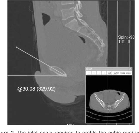 Figure 2 From Optimal Pelvic Inlet And Outlet Radiograph Angles In