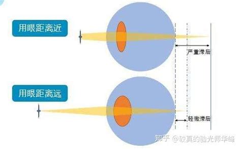 晶状体的调节功能与近视有什么关系 如何判断真假性近视 知乎