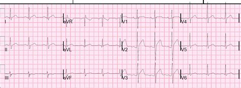 Dr Smiths Ecg Blog Several Cases Of St Elevation From Early Repolarization