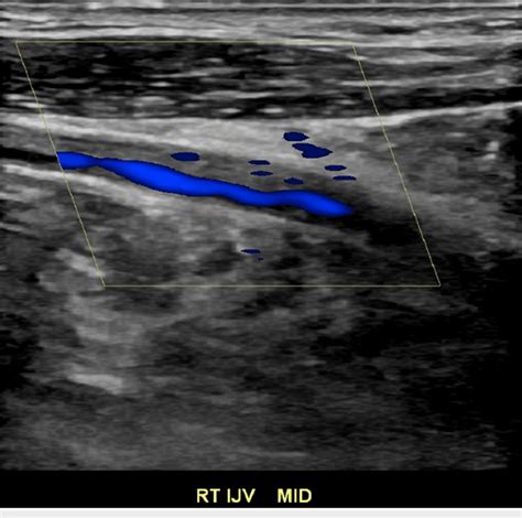 Doppler Evaluation Of The Internal Jugular Vein Showing Partially