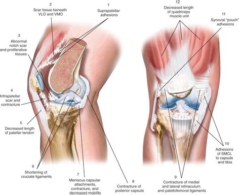 Prevention And Treatment Of Knee Arthrofibrosis Clinical Tree