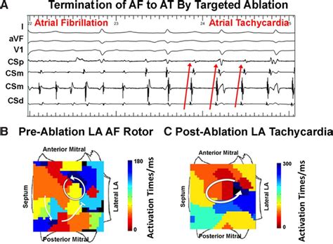 Mechanisms For The Termination Of Atrial Fibrillation By Localized