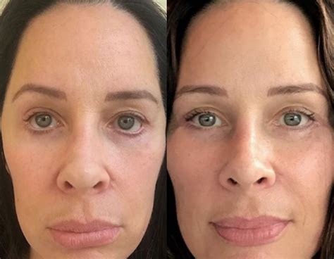 Lower Blepharoplasty Gone Wrong