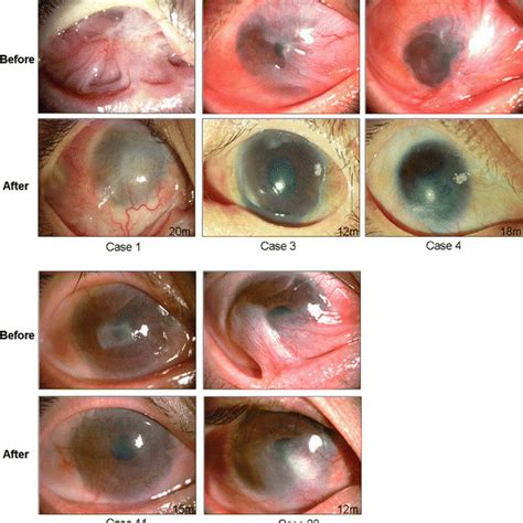 Corneal H And E Staining And Impression Cytology After Transplantation