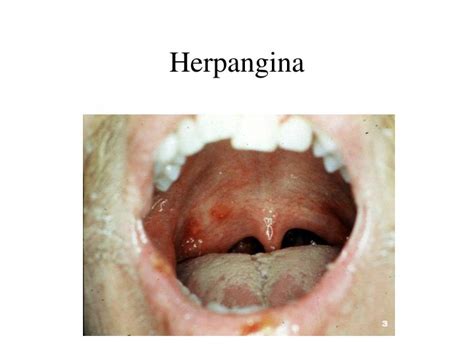 Herpangina In Adults
