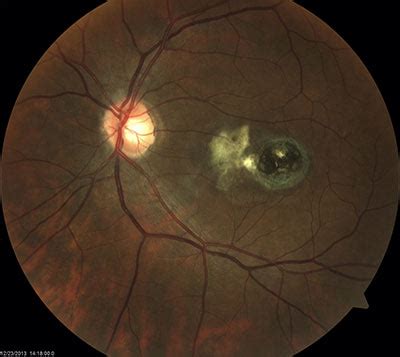 Histoplasmosis Retinopathy — The Low Vision Centers of Indiana