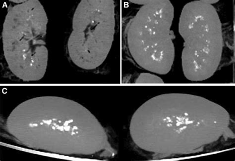 CT scans showing calcifications in the renal collecting system of a ...