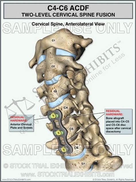 This Trial Exhibit Shows The Postoperative View Of A Two Level Acdf