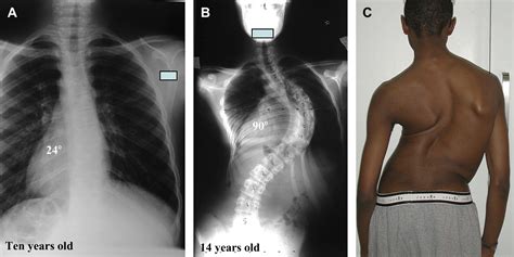 Scoliosis Progression