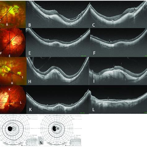 Dome Shaped Macula Dsm Co Existing With Macular Bruch S Membrane Download Scientific Diagram