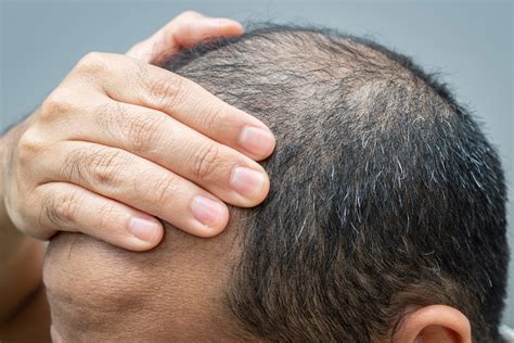 Crean Una Revolucionaria Pastilla Que Podría Acabar Con Un Tipo Concreto De Alopecia