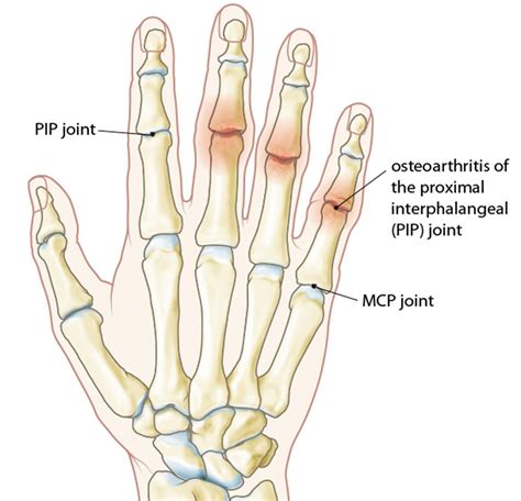 Arthritis | Grip Hand Therapy